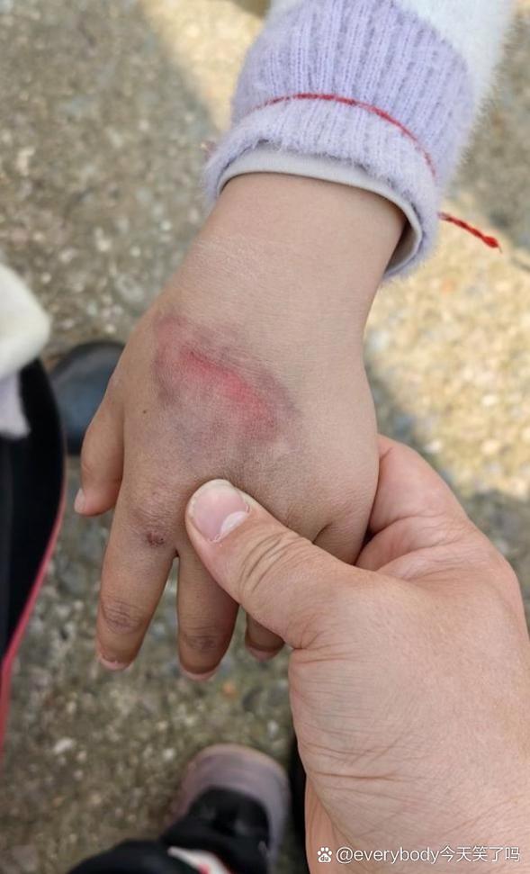 新生儿手上有淤青图片正常吗?需要警惕哪些潜在健康问题?-第1张图片-郑州医学网 新生儿手上有淤青图片正常吗?需要警惕哪些潜在健康问题?-第1张图片-郑州医学网