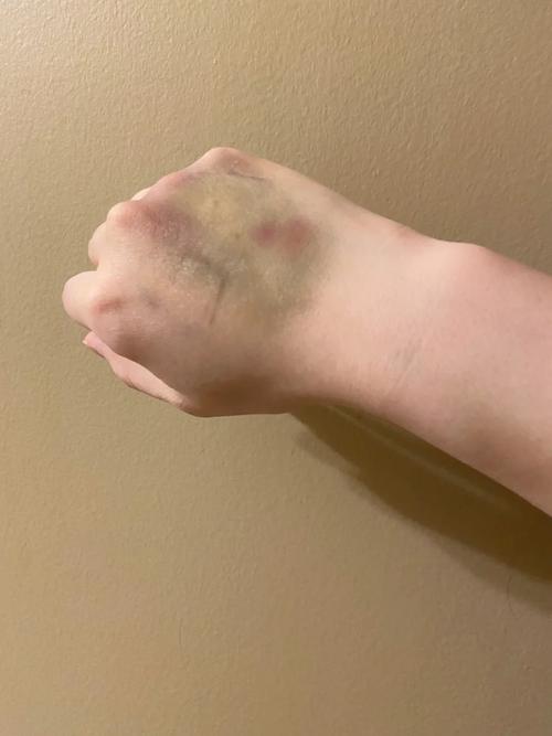 新生儿手上有淤青图片正常吗?需要警惕哪些潜在健康问题?-第3张图片-郑州医学网 新生儿手上有淤青图片正常吗?需要警惕哪些潜在健康问题?-第3张图片-郑州医学网