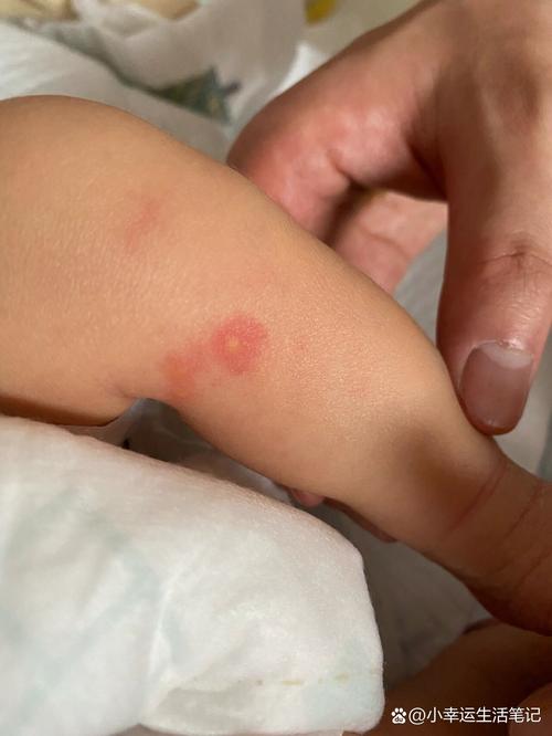 新生儿腿上起红疙瘩是湿疹还是过敏？该如何正确护理与处理？-第2张图片-郑州医学网