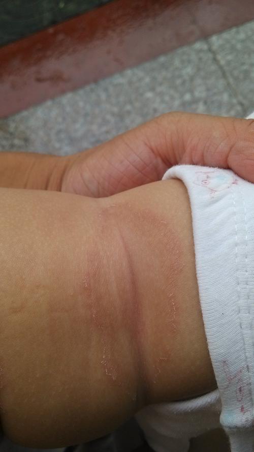 新生儿腿上起红疙瘩是湿疹还是过敏？该如何正确护理与处理？-第3张图片-郑州医学网