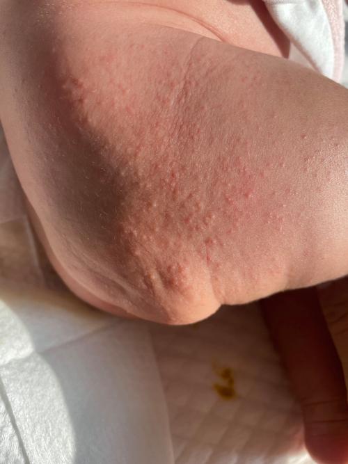新生儿腿上起红疙瘩是湿疹还是过敏？该如何正确护理与处理？-第1张图片-郑州医学网