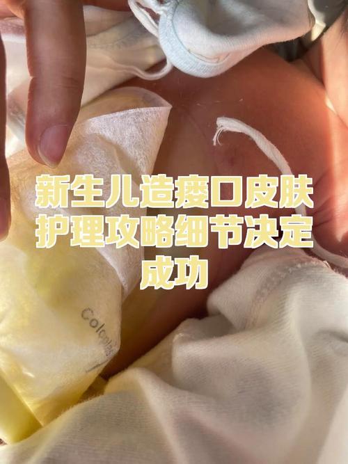 新生儿造瘘袋护理视频，如何正确佩戴、清洁及预防感染？-第3张图片-郑州医学网