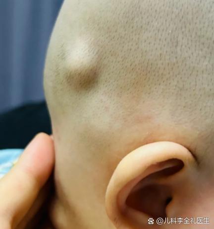 新生儿颅内囊肿常见吗?出现后需要立即治疗吗?-第1张图片-郑州医学网 新生儿颅内囊肿常见吗?出现后需要立即治疗吗?-第1张图片-郑州医学网