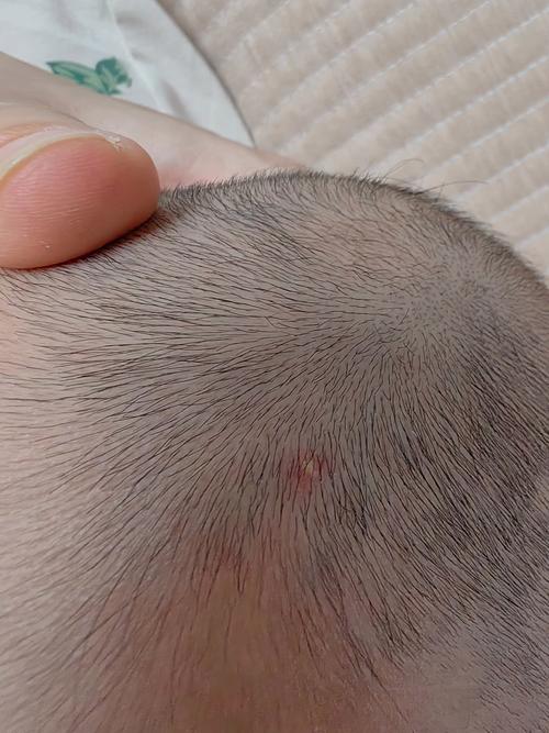 新生儿颅内囊肿常见吗?出现后需要立即治疗吗?-第2张图片-郑州医学网 新生儿颅内囊肿常见吗?出现后需要立即治疗吗?-第2张图片-郑州医学网