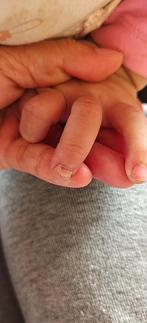 新生儿手指甲旁边掉皮是正常现象吗？需要担心感染或营养不良吗？-第1张图片-郑州医学网