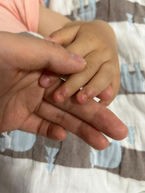 新生儿手指甲旁边掉皮是正常现象吗？需要担心感染或营养不良吗？-第2张图片-郑州医学网