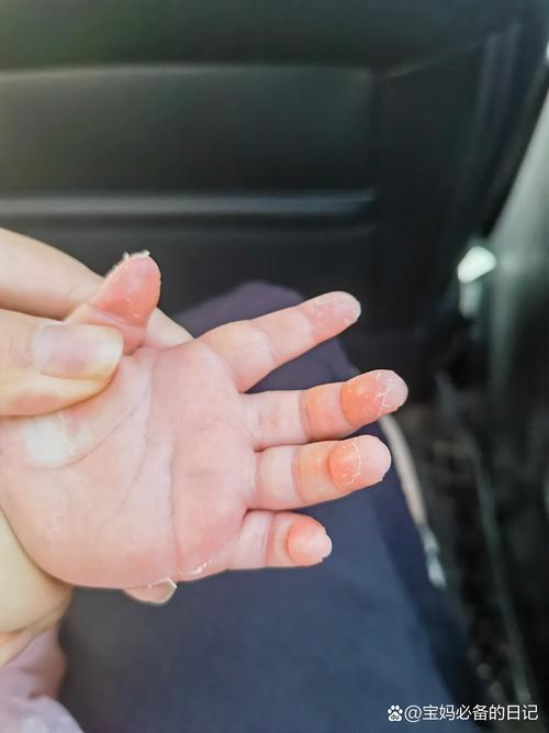 新生儿手指甲旁边掉皮是正常现象吗？需要担心感染或营养不良吗？-第3张图片-郑州医学网