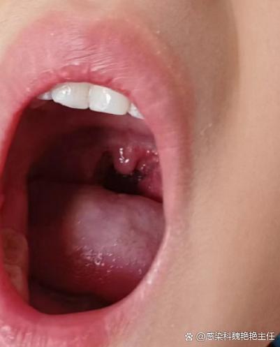 儿童感染支原体有哪些典型症状?家长该如何早期识别与应对?-第3张图片-郑州医学网 儿童感染支原体有哪些典型症状?家长该如何早期识别与应对?-第3张图片-郑州医学网