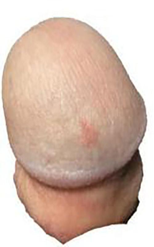 新生儿龟头炎初期照片有哪些典型症状？家长该如何正确护理？-第1张图片-郑州医学网