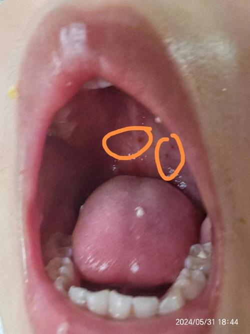 新生儿龟头炎初期照片有哪些典型症状？家长该如何正确护理？-第2张图片-郑州医学网