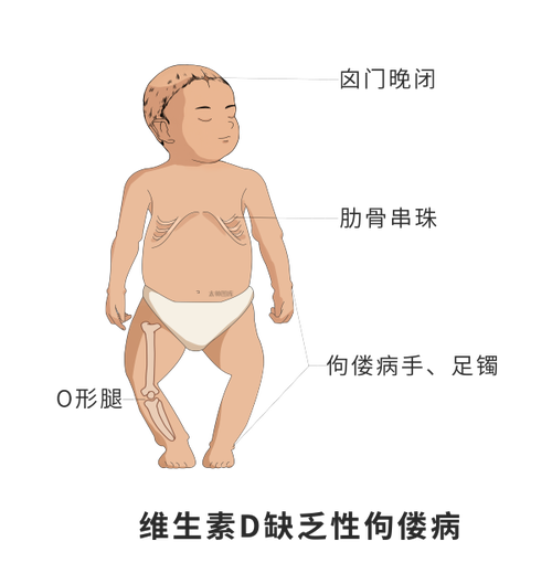 儿童缺维生素D会有哪些明显症状？如何通过日常表现及早发现？-第2张图片-郑州医学网