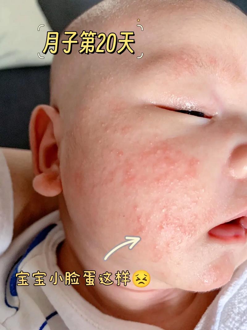 新生儿脸上长满小红点,是湿疹还是过敏?该如何护理才正确?-第2张图片-郑州医学网 新生儿脸上长满小红点,是湿疹还是过敏?该如何护理才正确?-第2张图片-郑州医学网