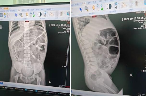 新生儿天生没有肛门，这种畸形真的能存活吗？-第2张图片-郑州医学网