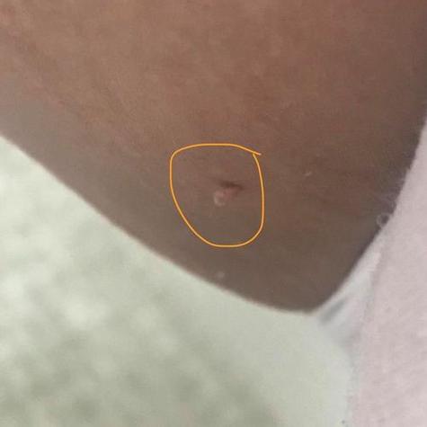 孕期乳头出现小肉疙瘩是什么原因？需要担心吗？会对哺乳有影响吗？-第2张图片-郑州医学网