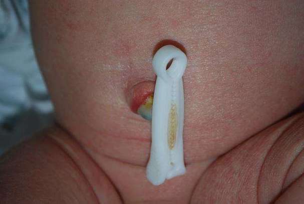 新生儿脐带未脱落有脓是感染吗?该如何处理才安全?-第2张图片-郑州医学网 新生儿脐带未脱落有脓是感染吗?该如何处理才安全?-第2张图片-郑州医学网