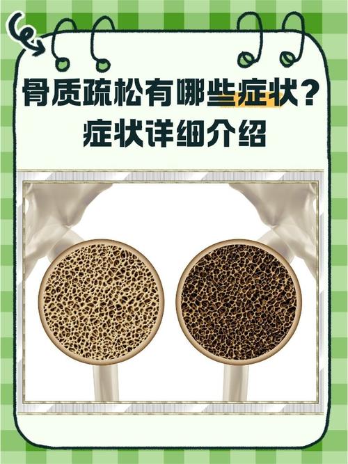 孕期骨质疏松是缺钙吗-第2张图片-郑州医学网