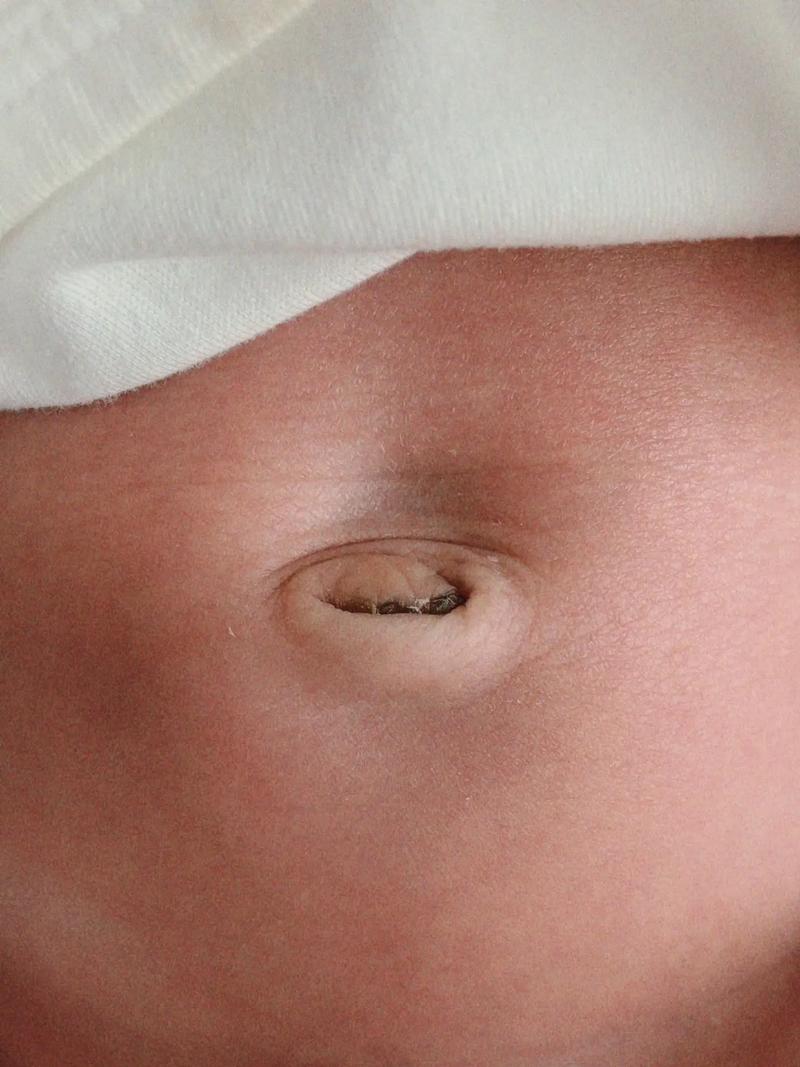 新生儿肚脐眼到底几天脱落?护理不当会影响愈合吗?-第1张图片-郑州医学网 新生儿肚脐眼到底几天脱落?护理不当会影响愈合吗?-第1张图片-郑州医学网