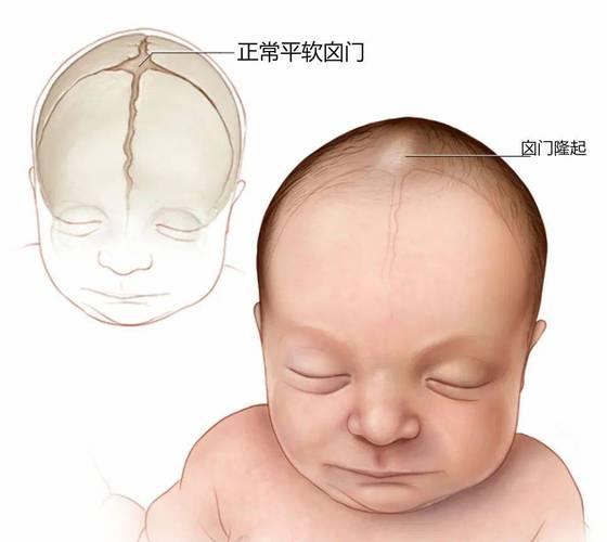 新生儿颅内囊肿一定会被吸收吗？吸收过程受哪些因素影响？-第1张图片-郑州医学网