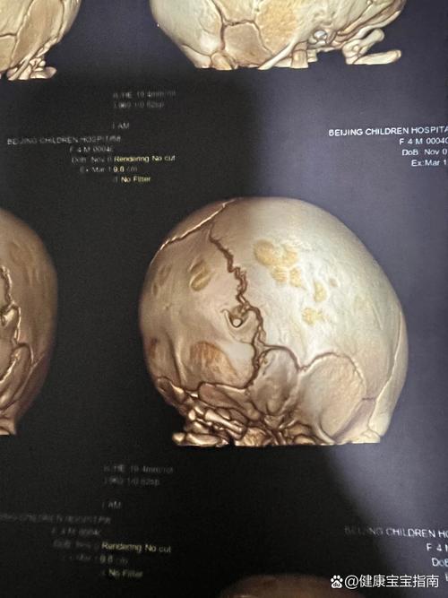 新生儿颅内囊肿一定会被吸收吗？吸收过程受哪些因素影响？-第3张图片-郑州医学网