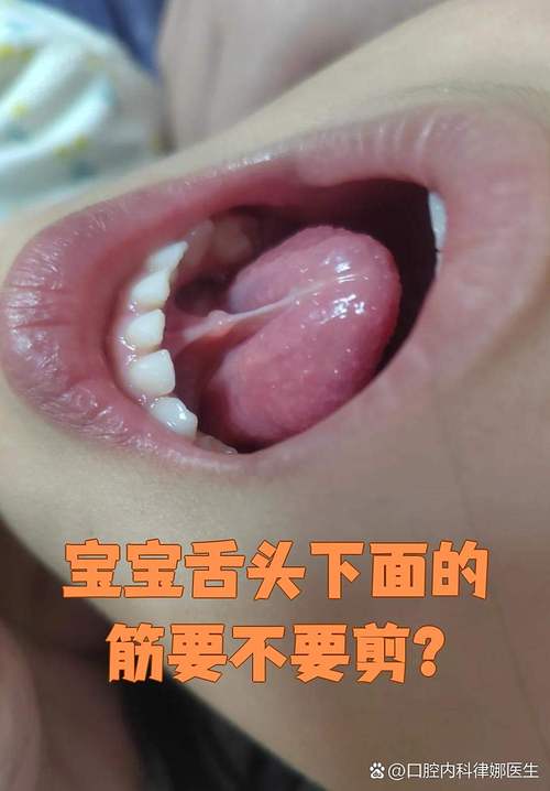 新生儿舌头下的筋短会影响吃奶和说话吗?需要手术吗?-第1张图片-郑州医学网 新生儿舌头下的筋短会影响吃奶和说话吗?需要手术吗?-第1张图片-郑州医学网