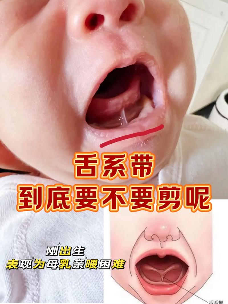 新生儿舌头下的筋短会影响吃奶和说话吗?需要手术吗?-第2张图片-郑州医学网 新生儿舌头下的筋短会影响吃奶和说话吗?需要手术吗?-第2张图片-郑州医学网
