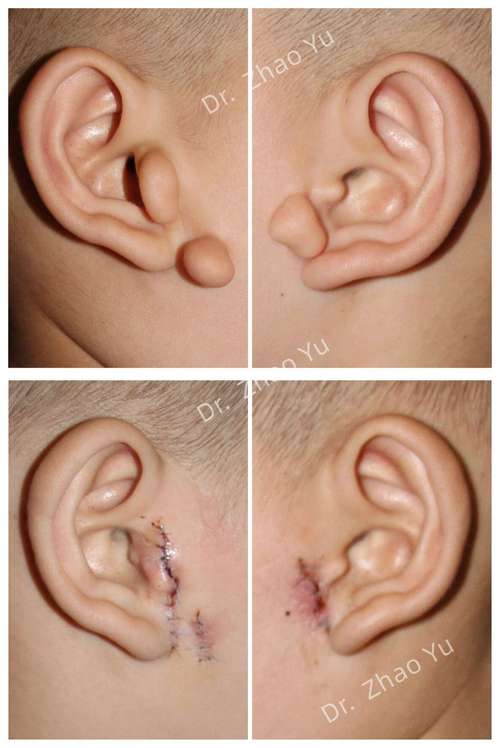 孕期怎么预防拴马桩耳-第3张图片-郑州医学网