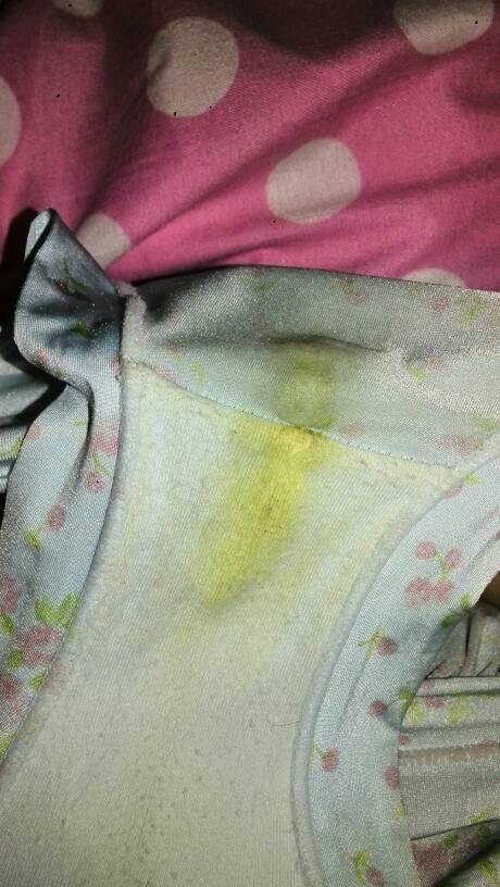 孕期下面流黄黄的东西，是正常分泌物还是感染信号？需要警惕哪些异常情况？-第2张图片-郑州医学网