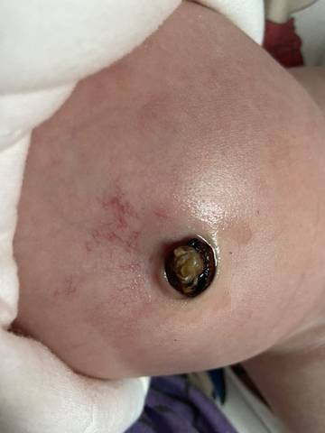 新生儿脐带上的白色橡皮圈到底有什么作用?需要多久才能自然脱落?-第1张图片-郑州医学网 新生儿脐带上的白色橡皮圈到底有什么作用?需要多久才能自然脱落?-第1张图片-郑州医学网