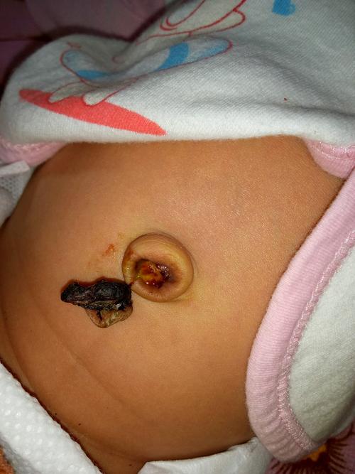 新生儿脐带上的白色橡皮圈到底有什么作用？需要多久才能自然脱落？-第2张图片-郑州医学网