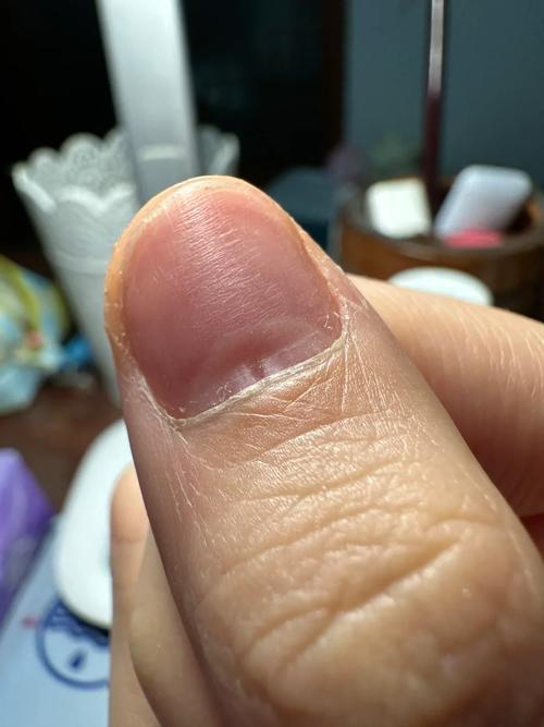 孕期指甲凹凸不平是缺钙还是疾病信号?附图片解析孕期指甲异常原因-第1张图片-郑州医学网 孕期指甲凹凸不平是缺钙还是疾病信号?附图片解析孕期指甲异常原因-第1张图片-郑州医学网