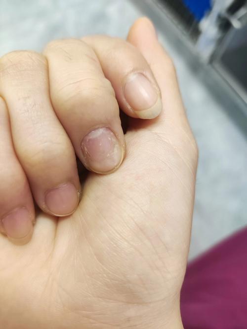 孕期指甲凹凸不平是缺钙还是疾病信号?附图片解析孕期指甲异常原因-第3张图片-郑州医学网 孕期指甲凹凸不平是缺钙还是疾病信号?附图片解析孕期指甲异常原因-第3张图片-郑州医学网