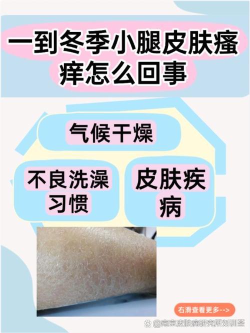 孕期腿部瘙痒是缺钙还是胆汁淤积？需要警惕哪些危险信号？-第2张图片-郑州医学网