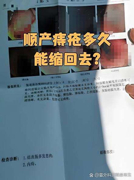 孕期遭遇痔疮困扰，顺产会加重症状吗？分娩方式该如何科学选择？-第1张图片-郑州医学网