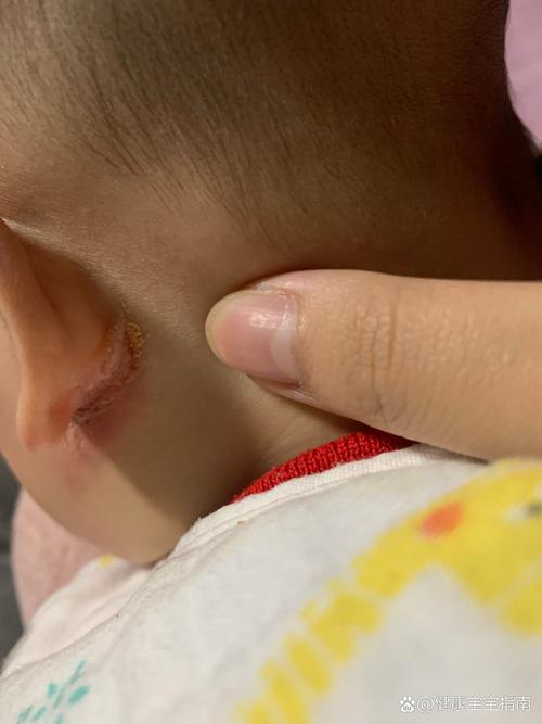 新生儿耳朵出现黄水结痂是正常现象还是感染信号?需要如何正确处理?-第2张图片-郑州医学网 新生儿耳朵出现黄水结痂是正常现象还是感染信号?需要如何正确处理?-第2张图片-郑州医学网