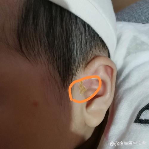 新生儿耳朵出现黄水结痂是正常现象还是感染信号?需要如何正确处理?-第1张图片-郑州医学网 新生儿耳朵出现黄水结痂是正常现象还是感染信号?需要如何正确处理?-第1张图片-郑州医学网