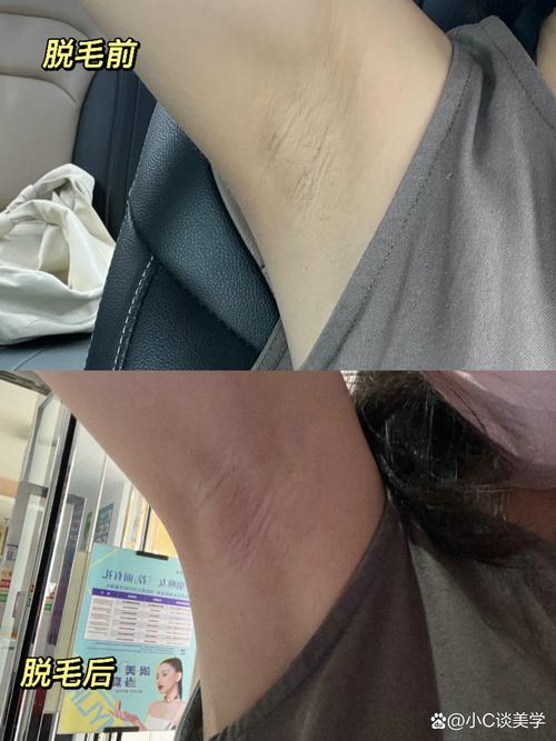 孕期激光脱毛安全吗？会对胎儿有影响吗？-第3张图片-郑州医学网