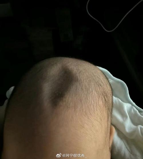 不小心打到新生儿囟门后，家长该如何判断和处理？-第1张图片-郑州医学网