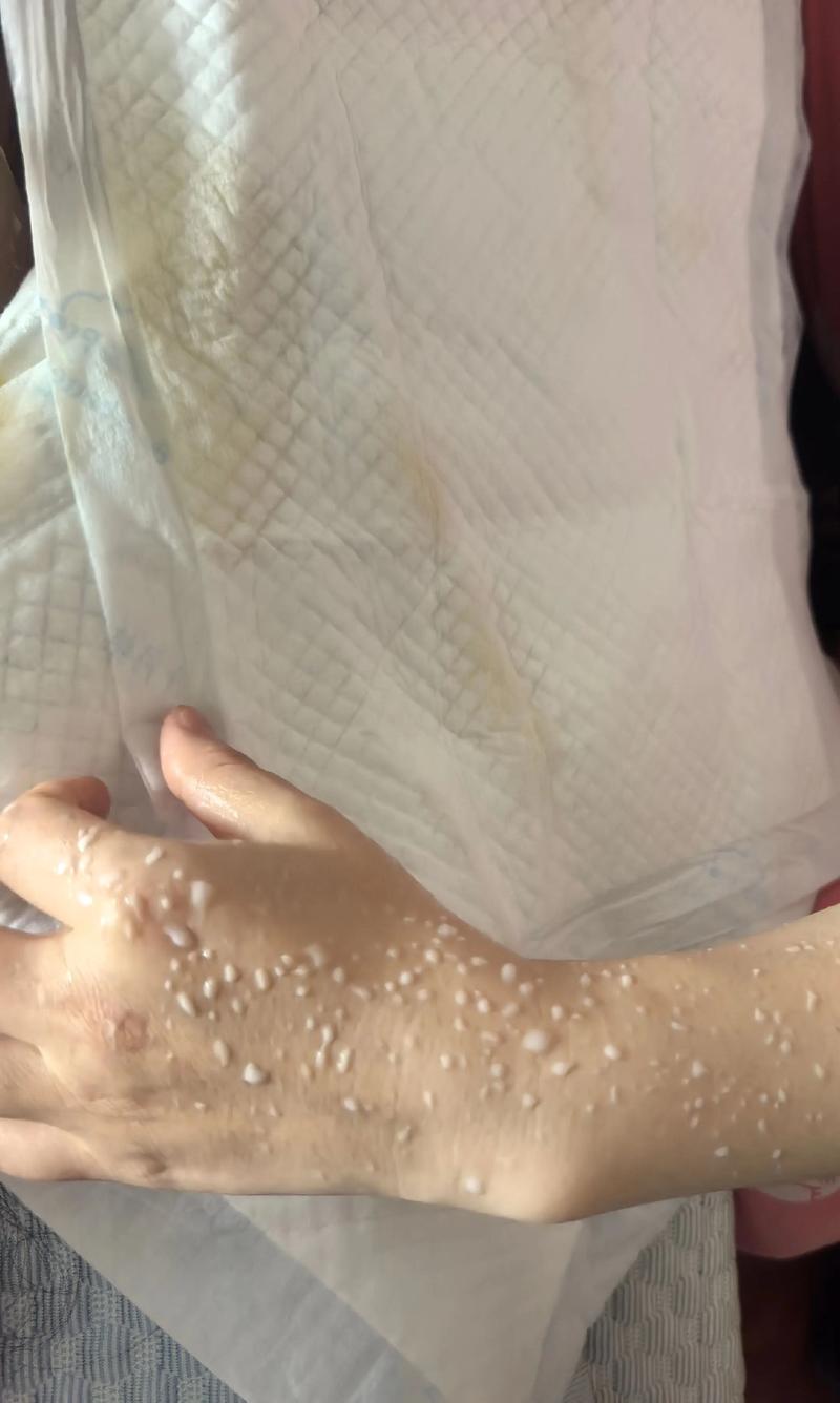 新生儿乳房挤出白色液体是正常现象吗？需要处理吗？-第1张图片-郑州医学网