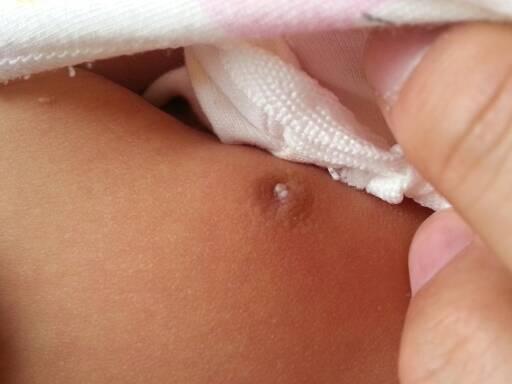 新生儿乳房挤出白色液体是正常现象吗？需要处理吗？-第2张图片-郑州医学网