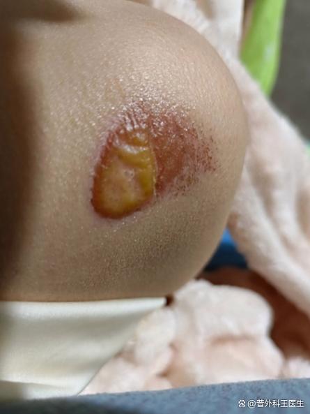 新生儿脓疱疹是否需要住院治疗，取决于病情严重程度吗？-第1张图片-郑州医学网