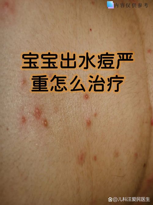 新生儿脓疱疹是否需要住院治疗，取决于病情严重程度吗？-第2张图片-郑州医学网