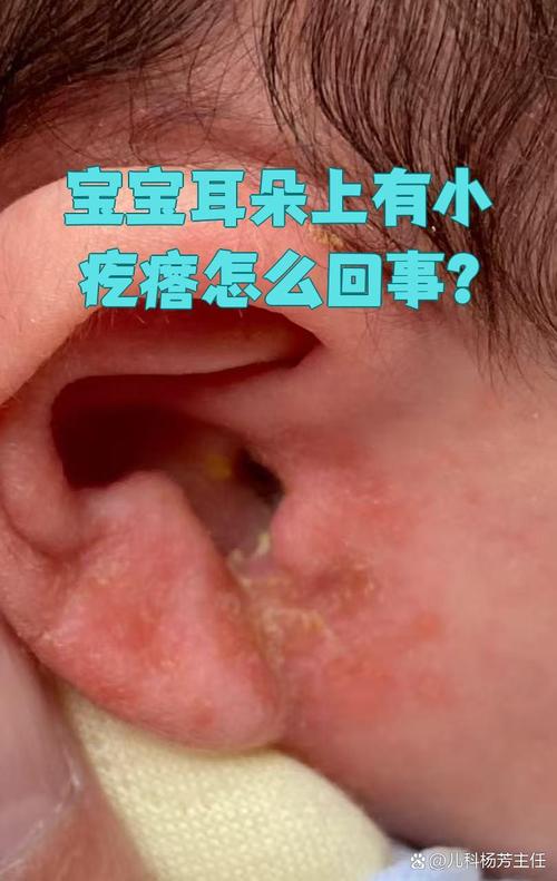 新生儿耳朵边有个小包-第2张图片-郑州医学网