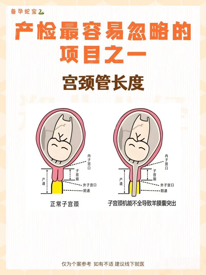 孕期宫颈短如何有效延长？科学方法与医学干预全解析-第2张图片-郑州医学网