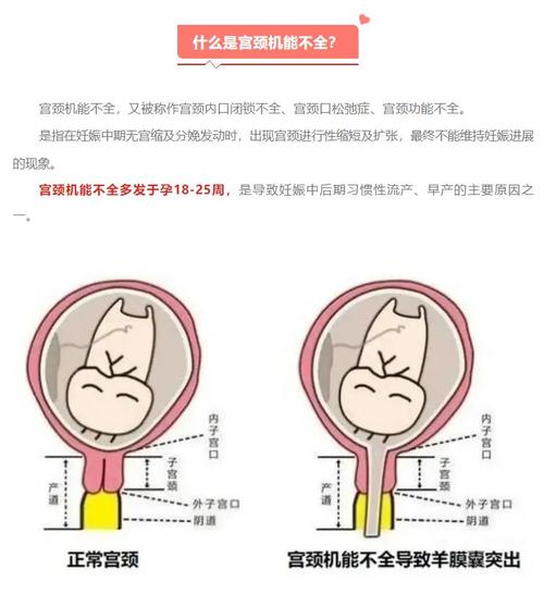 孕期宫颈短如何有效延长？科学方法与医学干预全解析-第3张图片-郑州医学网