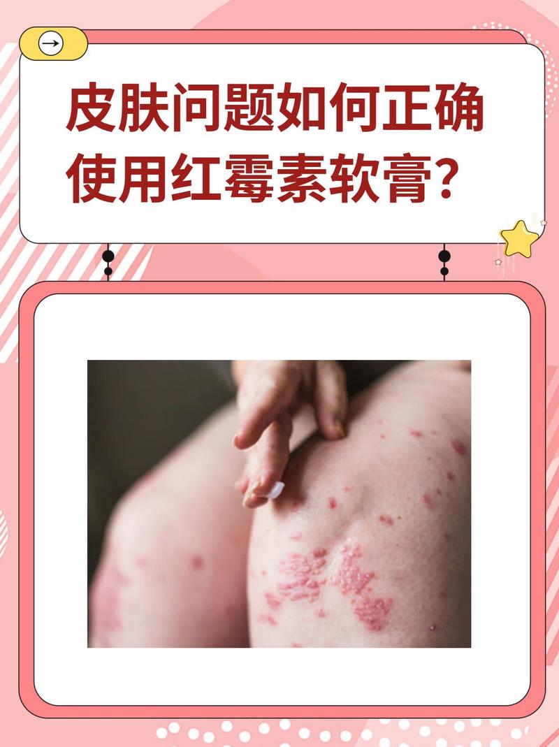 孕期使用红霉素软膏到底安全吗？对胎儿会有影响吗？-第2张图片-郑州医学网