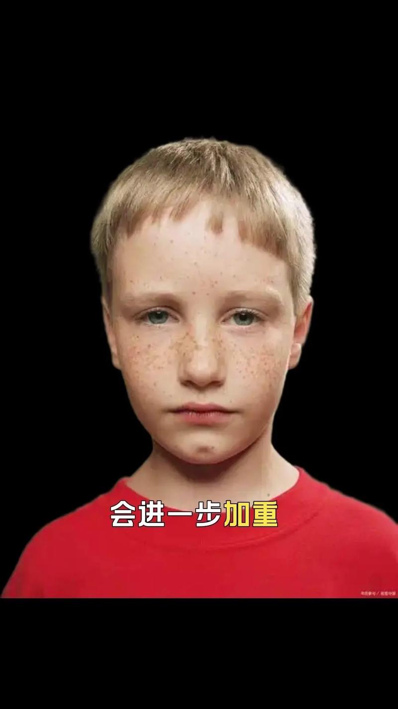 儿童脸上长斑点怎么办-第2张图片-郑州医学网