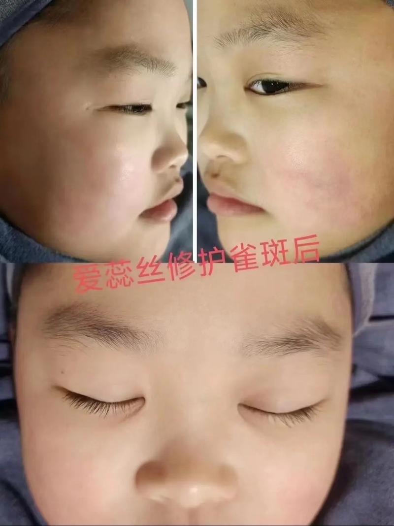 儿童脸上长斑点怎么办-第1张图片-郑州医学网