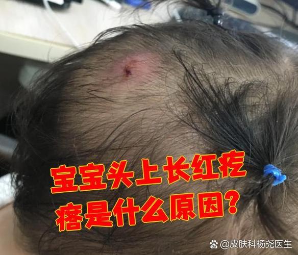 新生儿毛囊炎症状图片有哪些典型表现？如何区分与其他皮肤问题？-第1张图片-郑州医学网