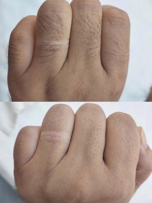 5岁儿童脱发怎么办？安全有效的脱毛方法有哪些？-第1张图片-郑州医学网