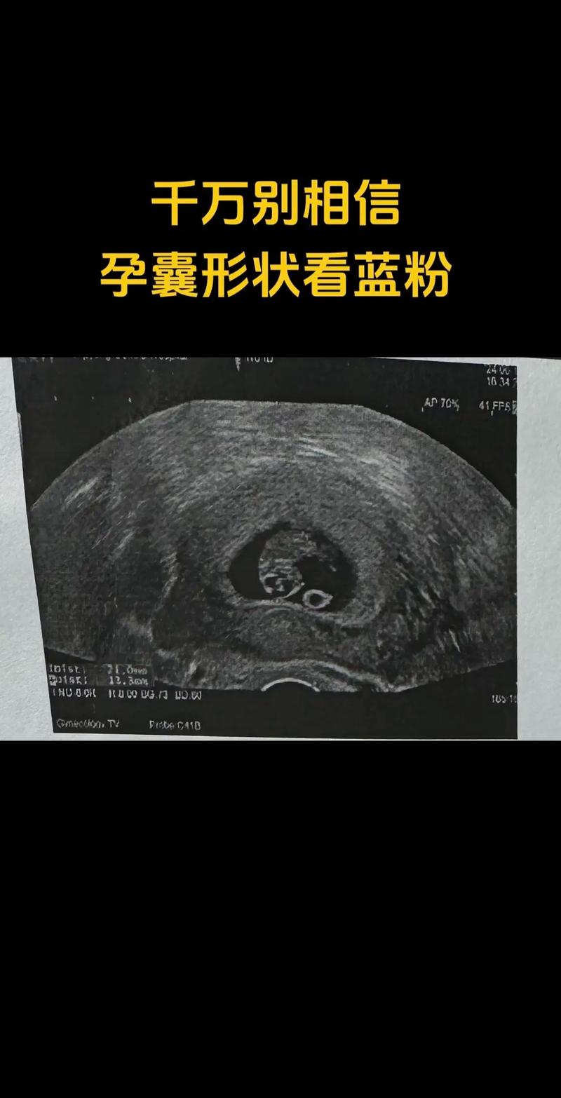 孕囊偏大与停经周数不符，是胎儿发育异常还是孕周计算有误？-第2张图片-郑州医学网